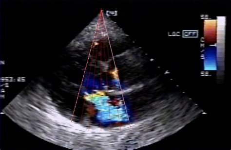 Doppler echocardiography .